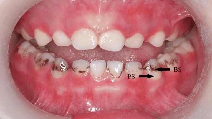 Ученые раскрыли секрет опасных микробов на зубах